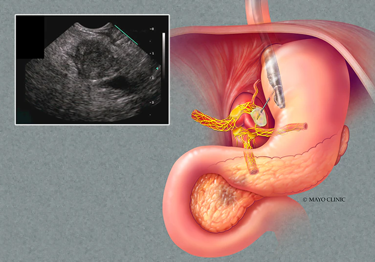 Fine Needle Aspiration_FNB